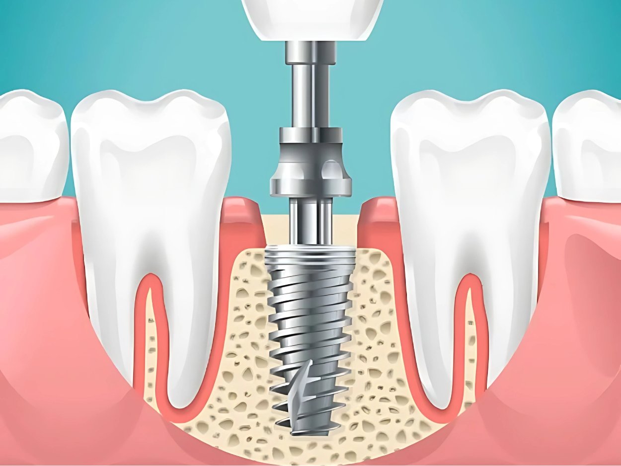 dental implant