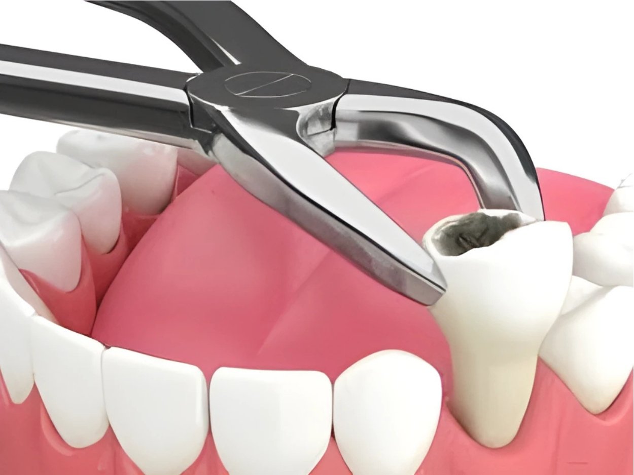 extractions