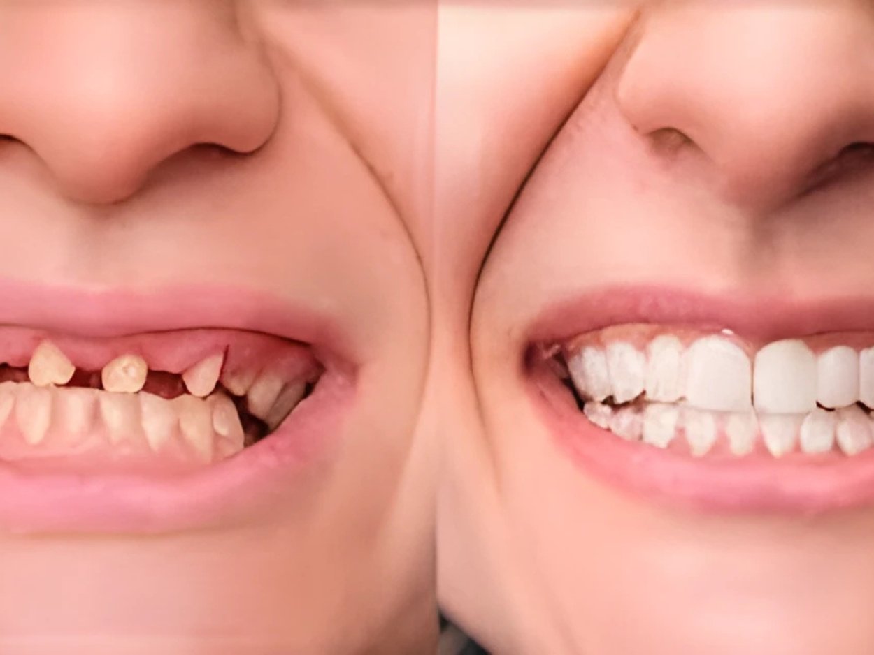 full mouth rehab