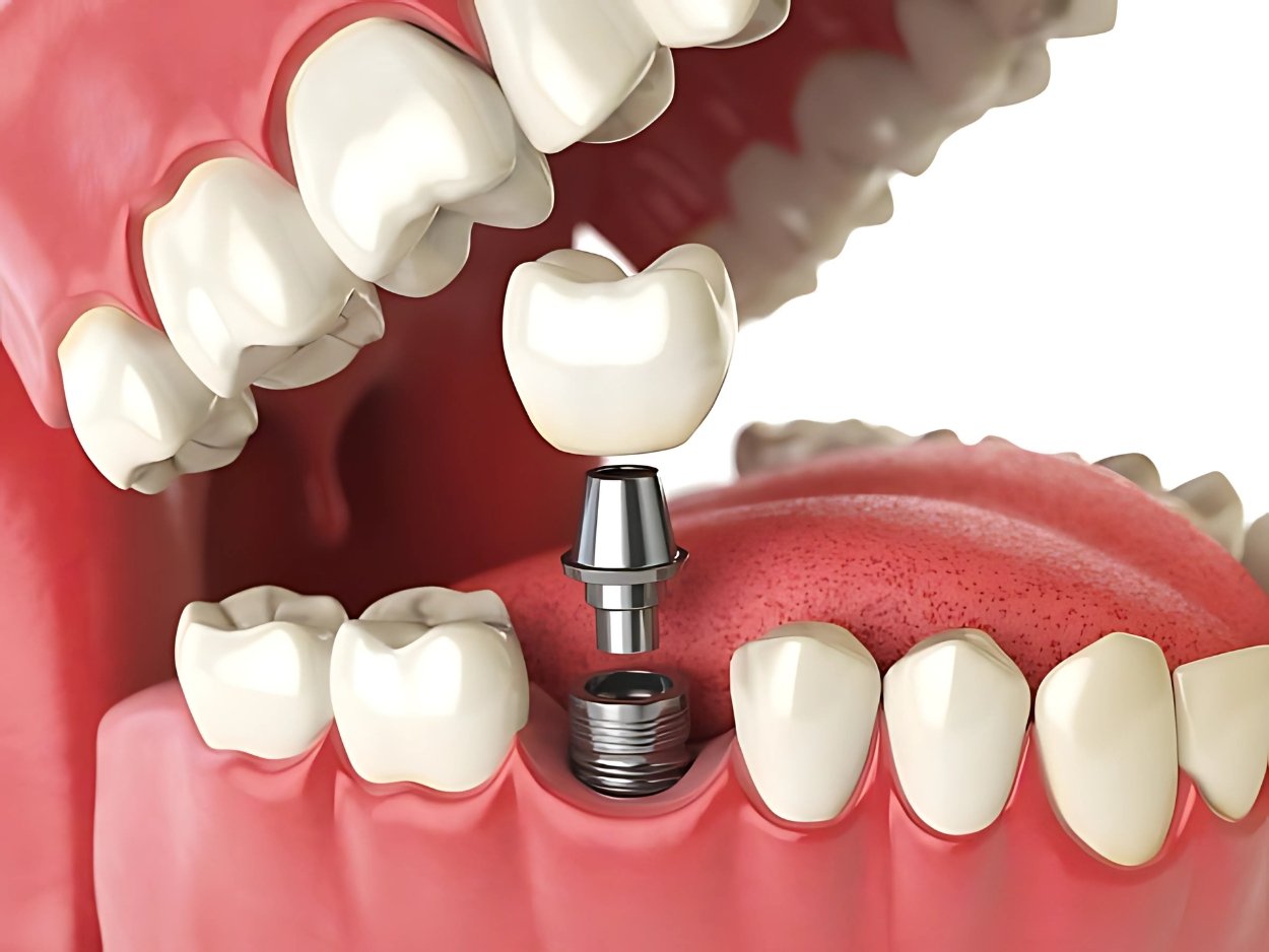 removable and fix dentures