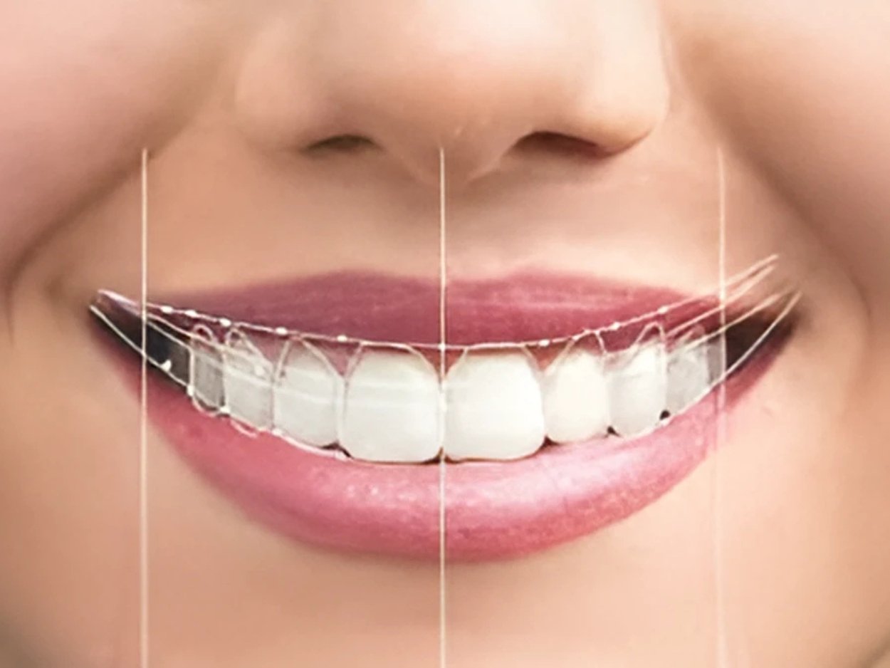 smile designing
