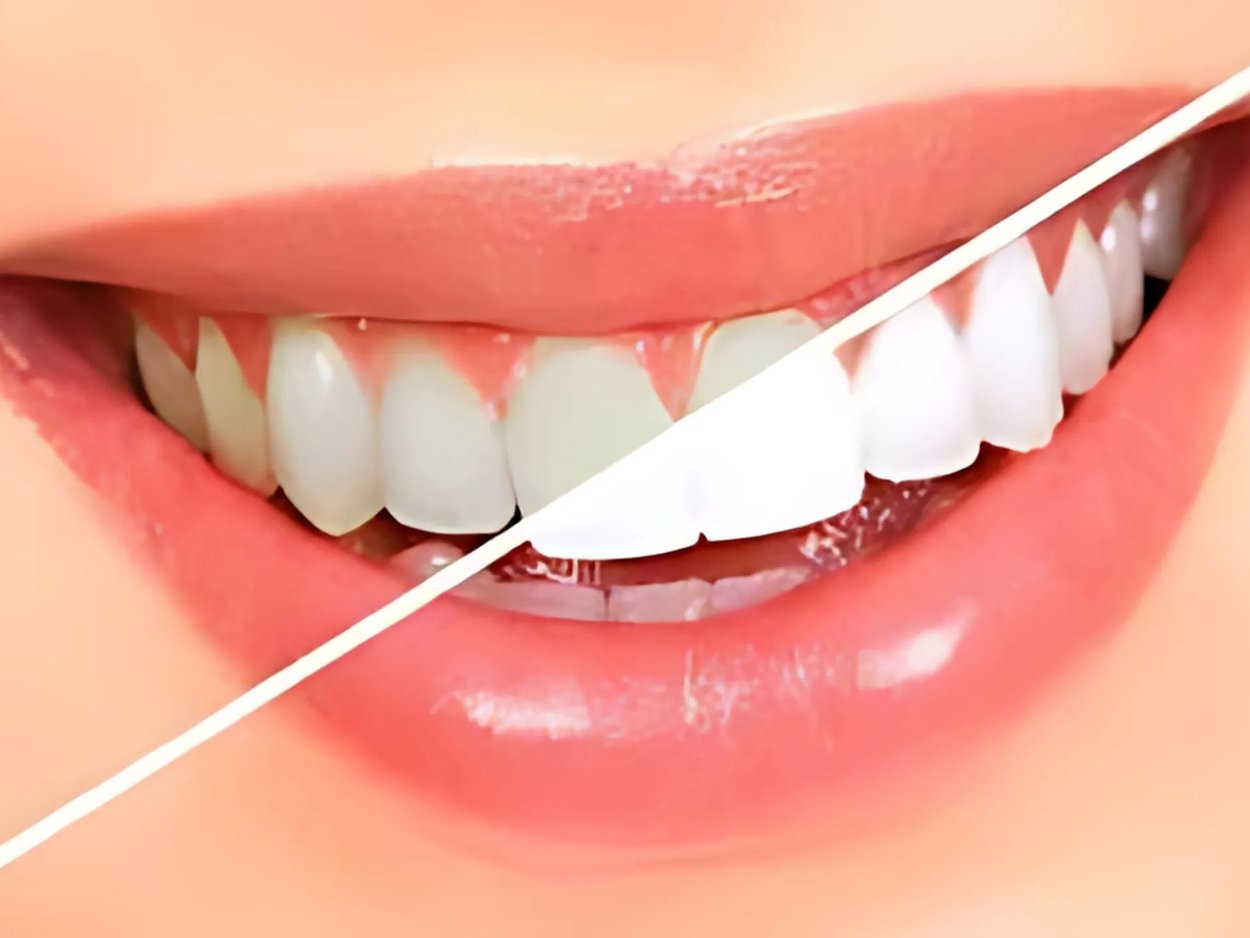 teeth whitening (bleaching)